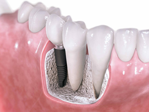 Dental-Implants.jpg